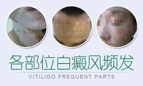各部位白癜风频发