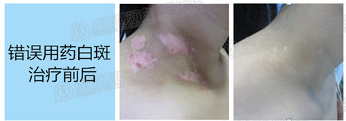 精确检测帮助各类型白癜风恢复